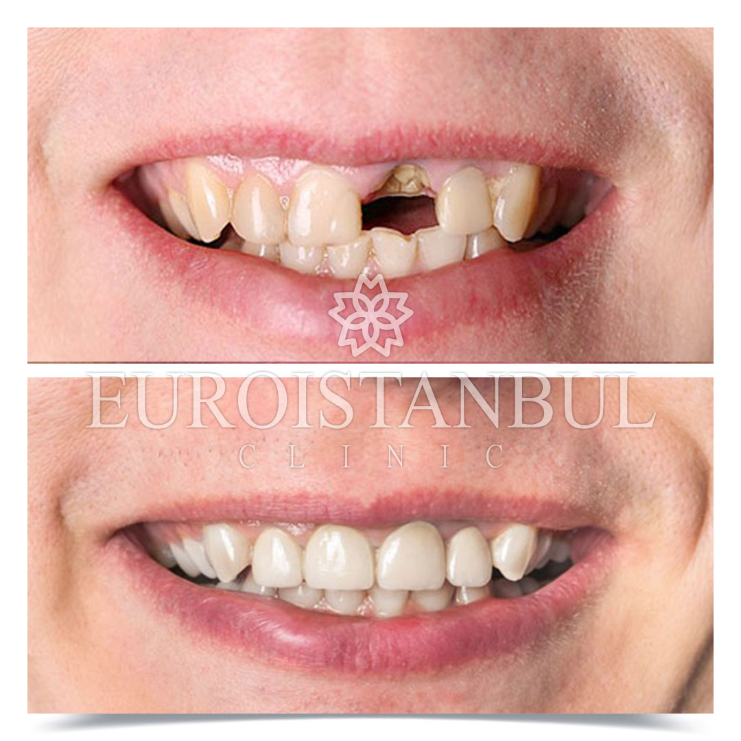 Dental Treatment Before After Photos Turkey