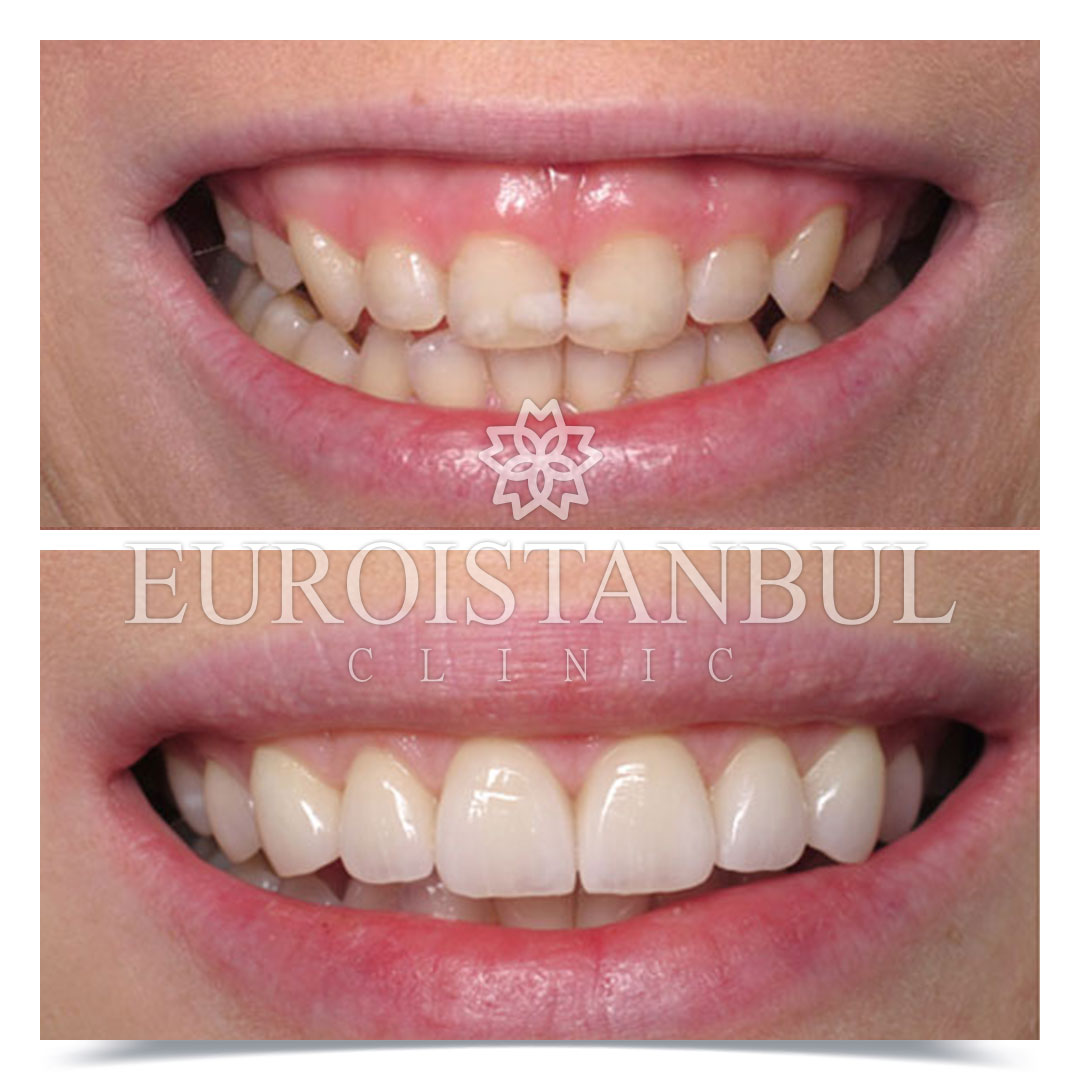 Dental Treatment Before After Photos Turkey