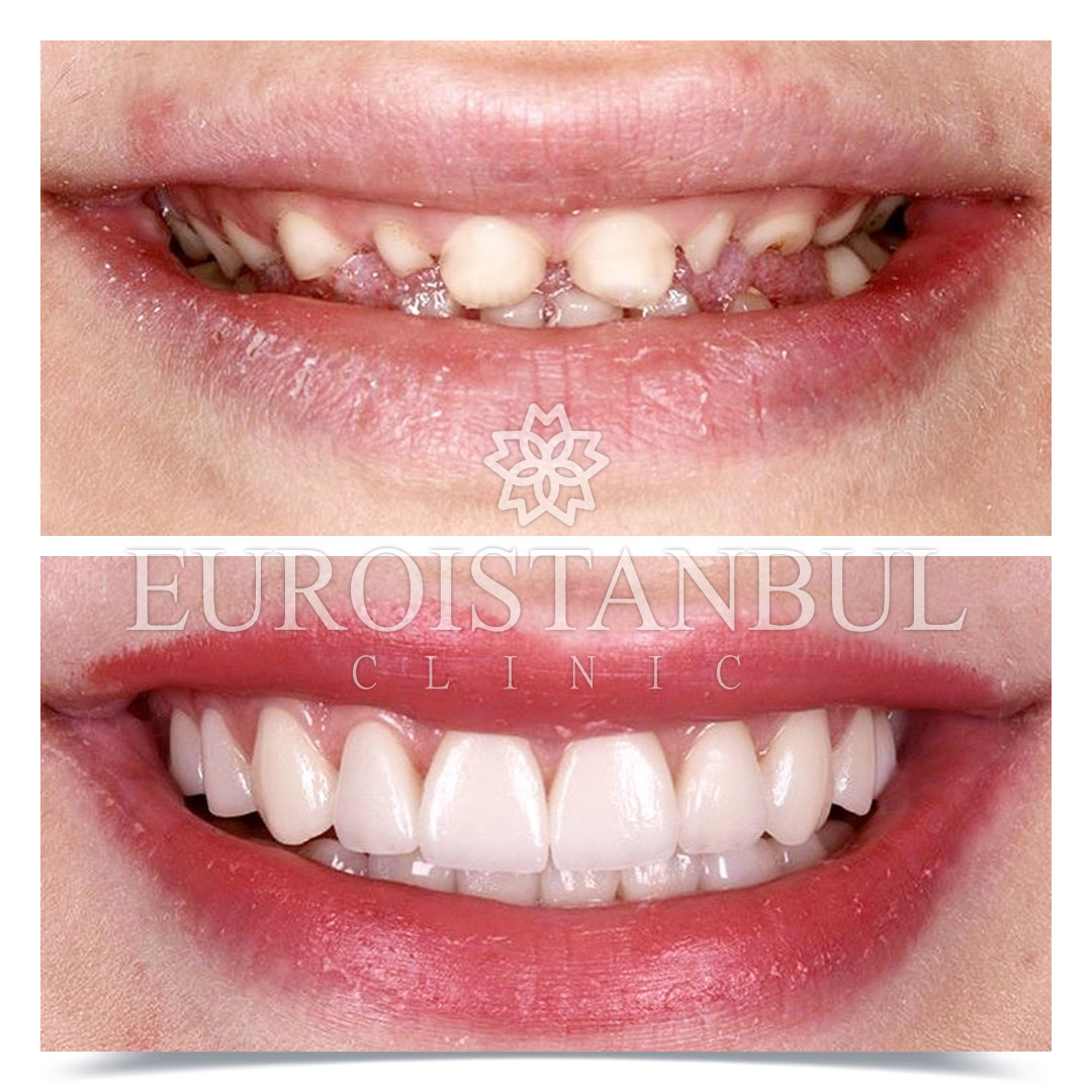 Dental Treatment Before After Photos Turkey