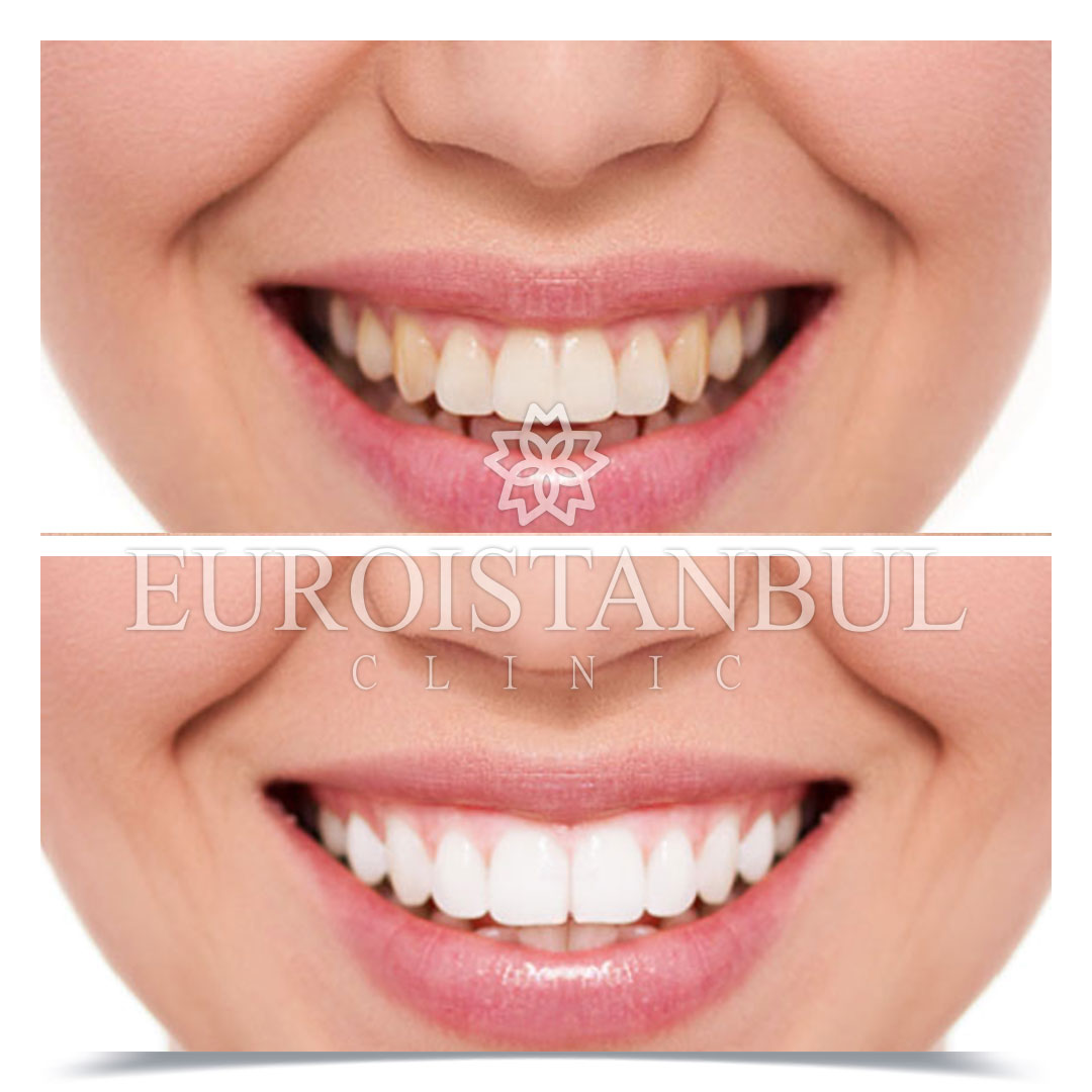 Dental Treatment Before After Photos Turkey