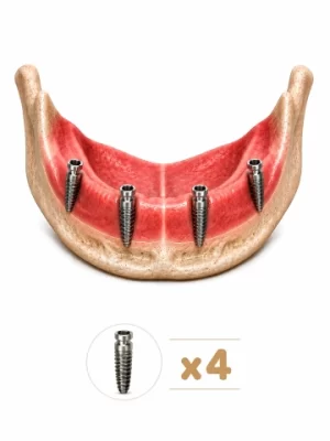 all-on-4-dental-implant-turkey https://www.euroistanbuldental.com/wp-content/uploads/all-on-4-dental-implant-turkey-300x400.webp