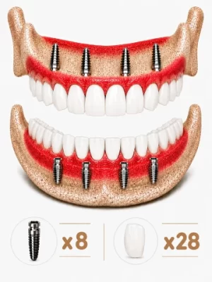 all-on-4-dental-implant-turkey-8-28 https://www.euroistanbuldental.com/wp-content/uploads/all-on-4-dental-implant-turkey-8-28-300x400.webp
