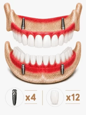 https://www.euroistanbuldental.com/wp-content/uploads/all-on-4-dental-implant-turkey-cost-300x400.webp