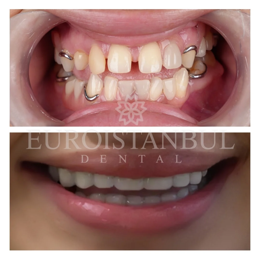 all-on-4-implant-istanbul
