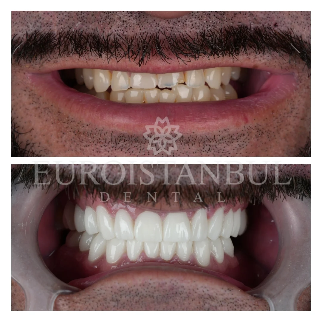 all-on-4-implant-turkey