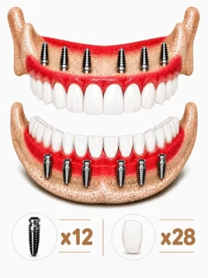 all-on-6-dental-implant-istanbul-12-28 https://www.euroistanbuldental.com/wp-content/uploads/all-on-6-dental-implant-istanbul-12-28-300x400.webp