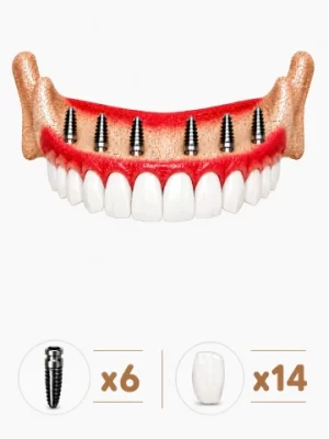all-on-6-dental-implant-istanbul-6-14 https://www.euroistanbuldental.com/wp-content/uploads/all-on-6-dental-implant-istanbul-6-14-300x400.webp