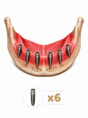 https://www.euroistanbuldental.com/wp-content/uploads/all-on-6-dental-implant-turkey-300x400.webp
