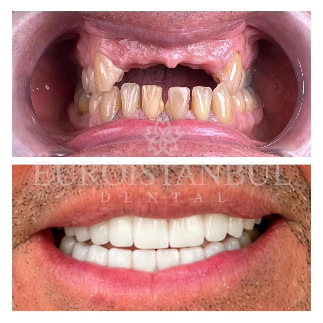 all-on-6-implant-istanbul