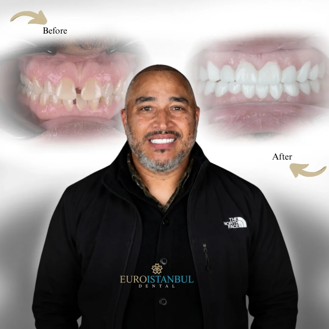 dental-crown-istanbul