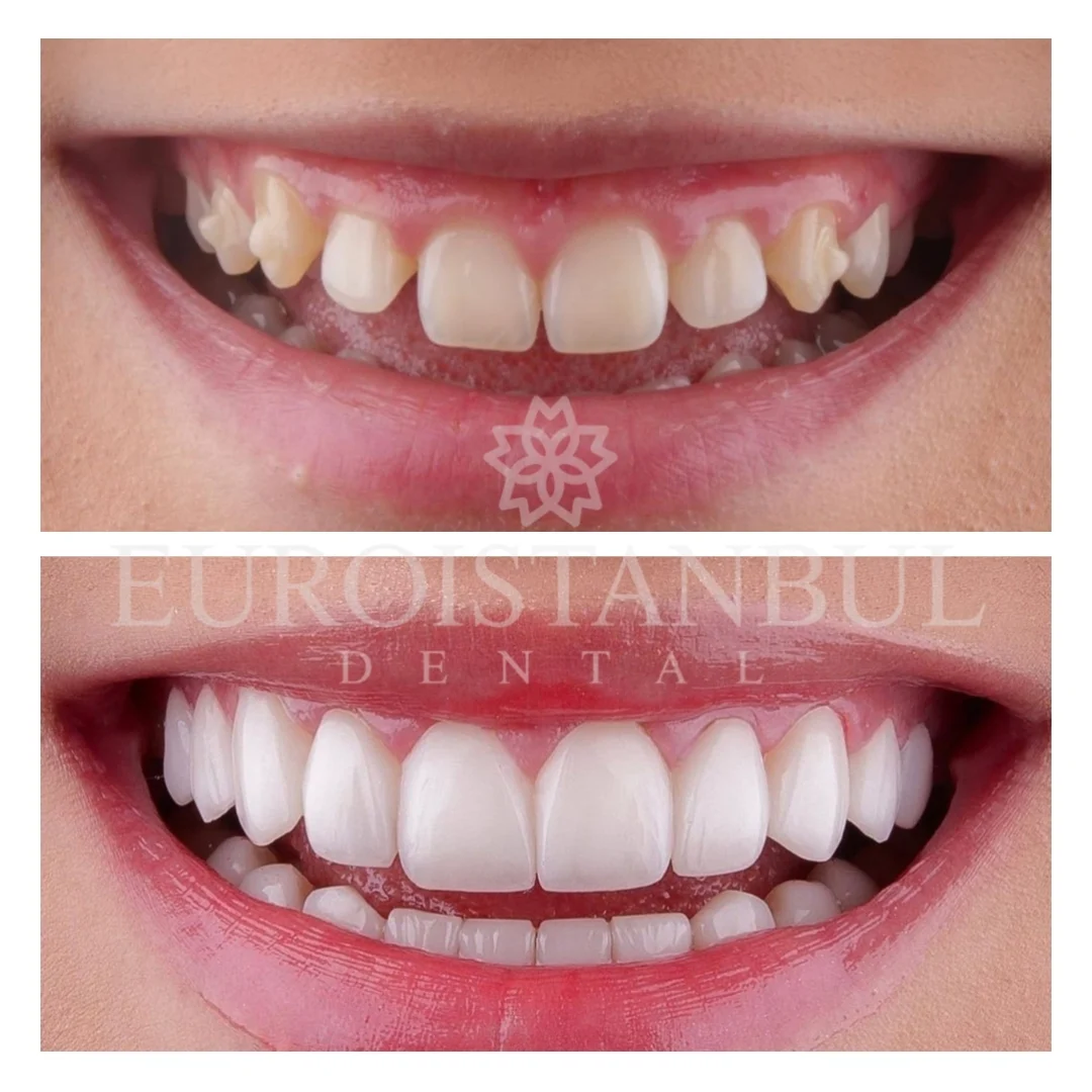 dental-crown-turkey-11