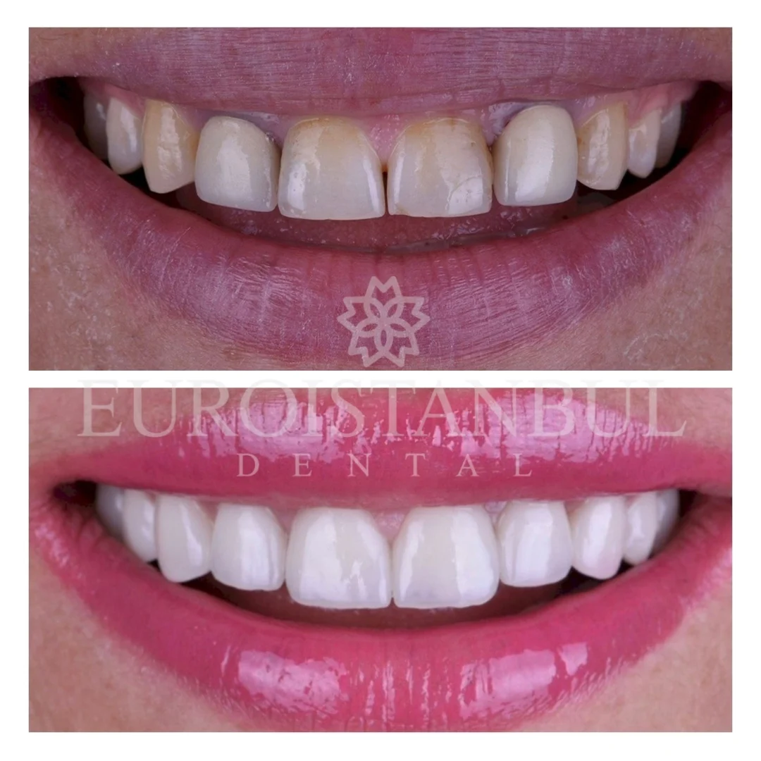 dental-crown-turkey-12