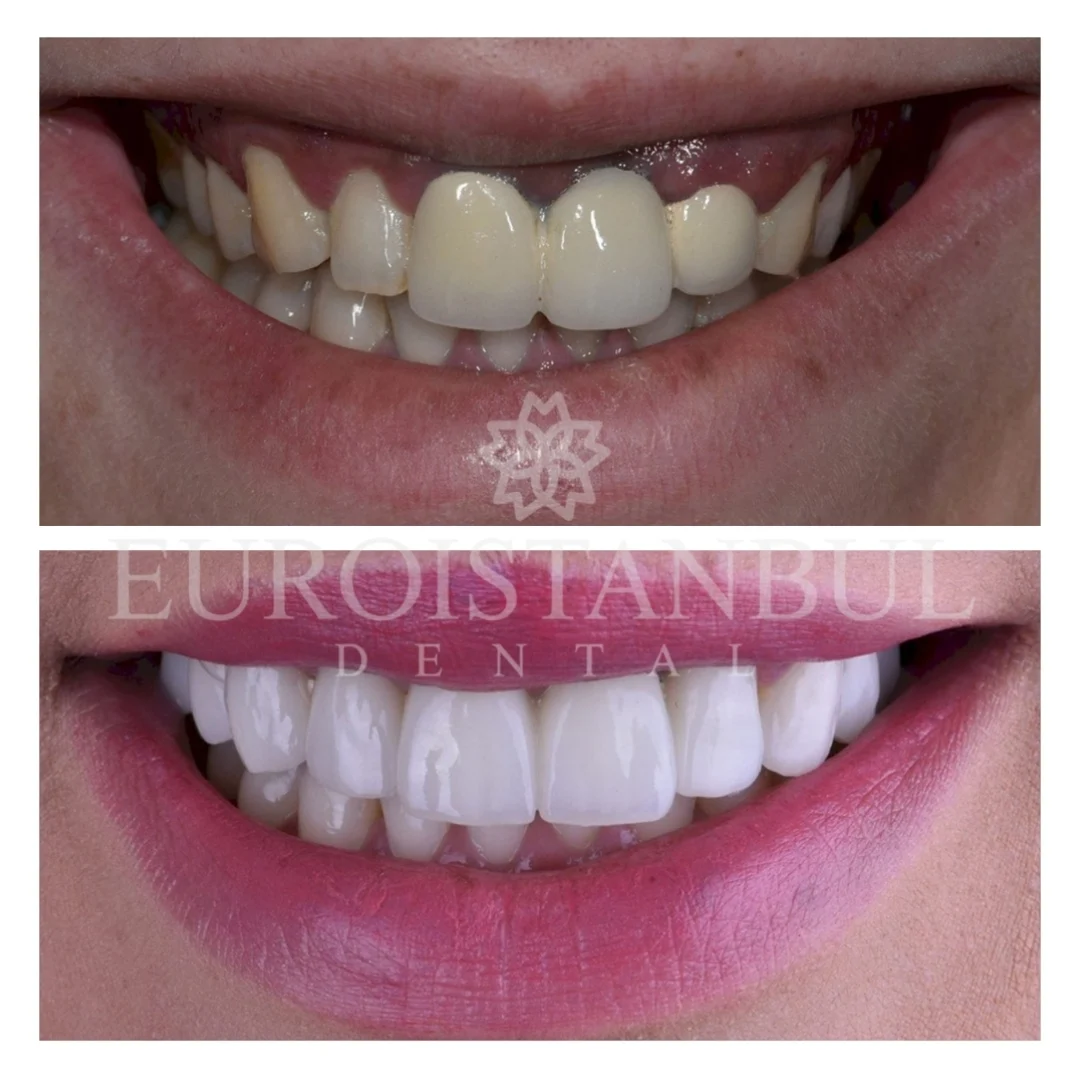 dental-crown-turkey-13