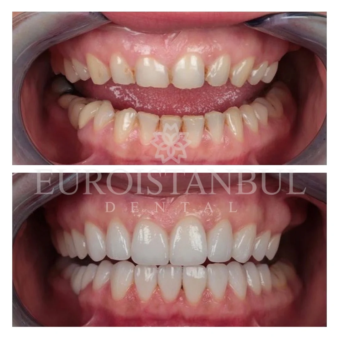 dental-crown-turkey-14