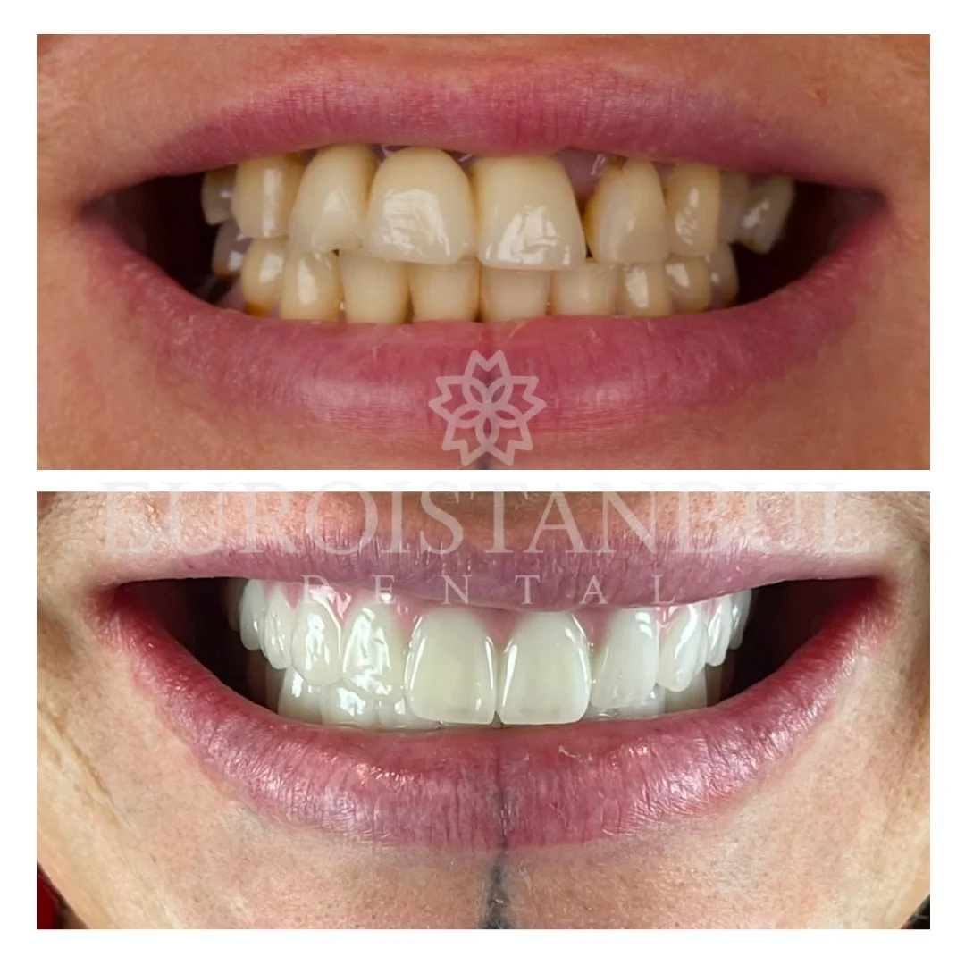 dental-crown-turkey-15