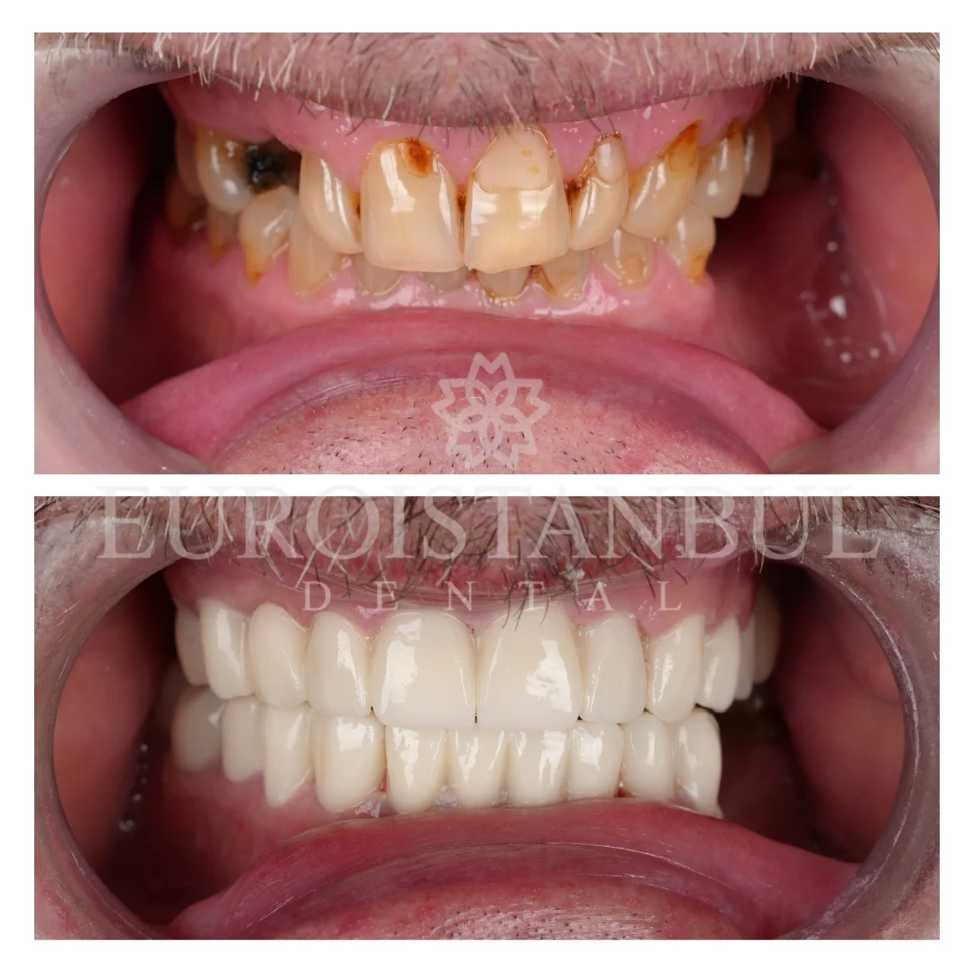 dental-crown-turkey-cost-2