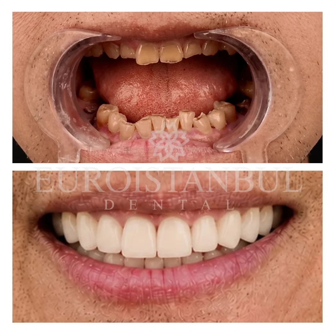dental-crown-turkey-cost