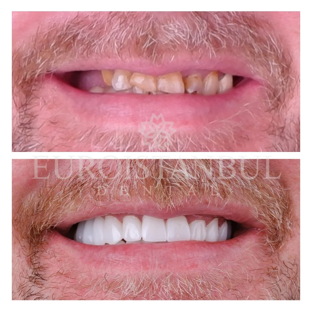 dental-crown-turkey-istanbul-14