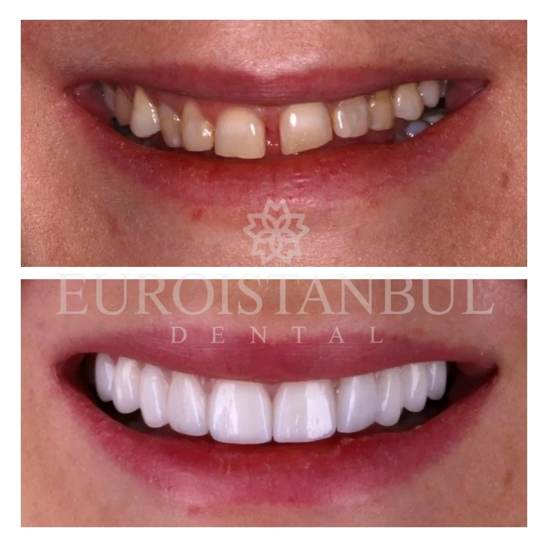 dental-crown-turkey-istanbul-15