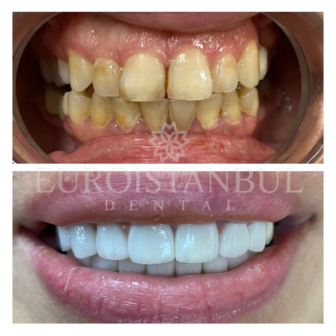 dental-crown-turkey-istanbul-16