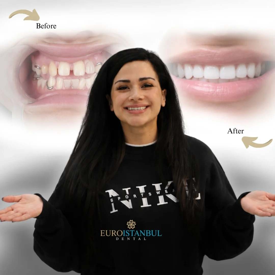 dental-crown-turkey-price