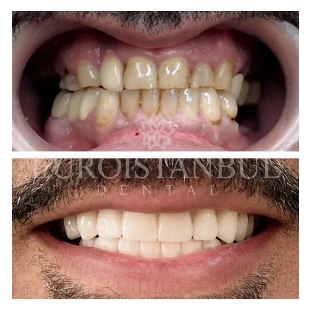 dental-crown-turkey-prices