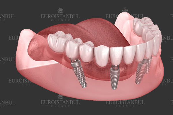 dental-implant-3d-mouth https://www.euroistanbuldental.com/wp-content/uploads/dental-implant-3d-mouth.jpg