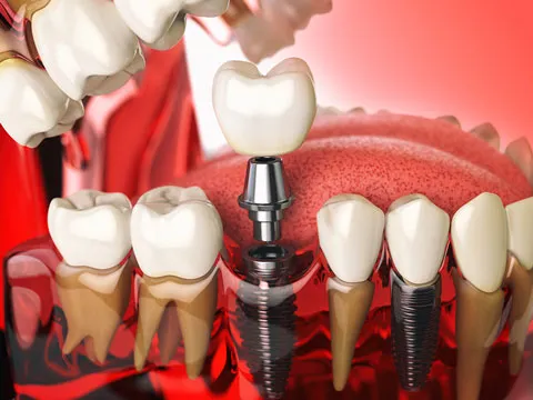 dental-implant-list