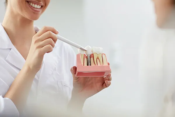 dental-implant-stages https://www.euroistanbuldental.com/wp-content/uploads/dental-implant-stages.webp