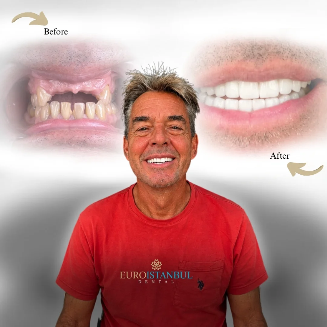 dental-implants-turkey-1