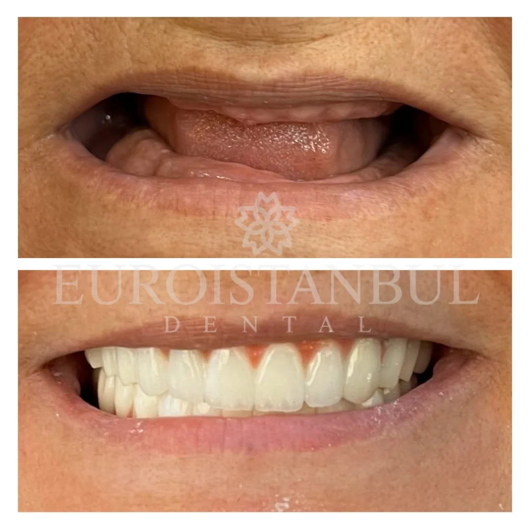 dental-implants-turkey-11