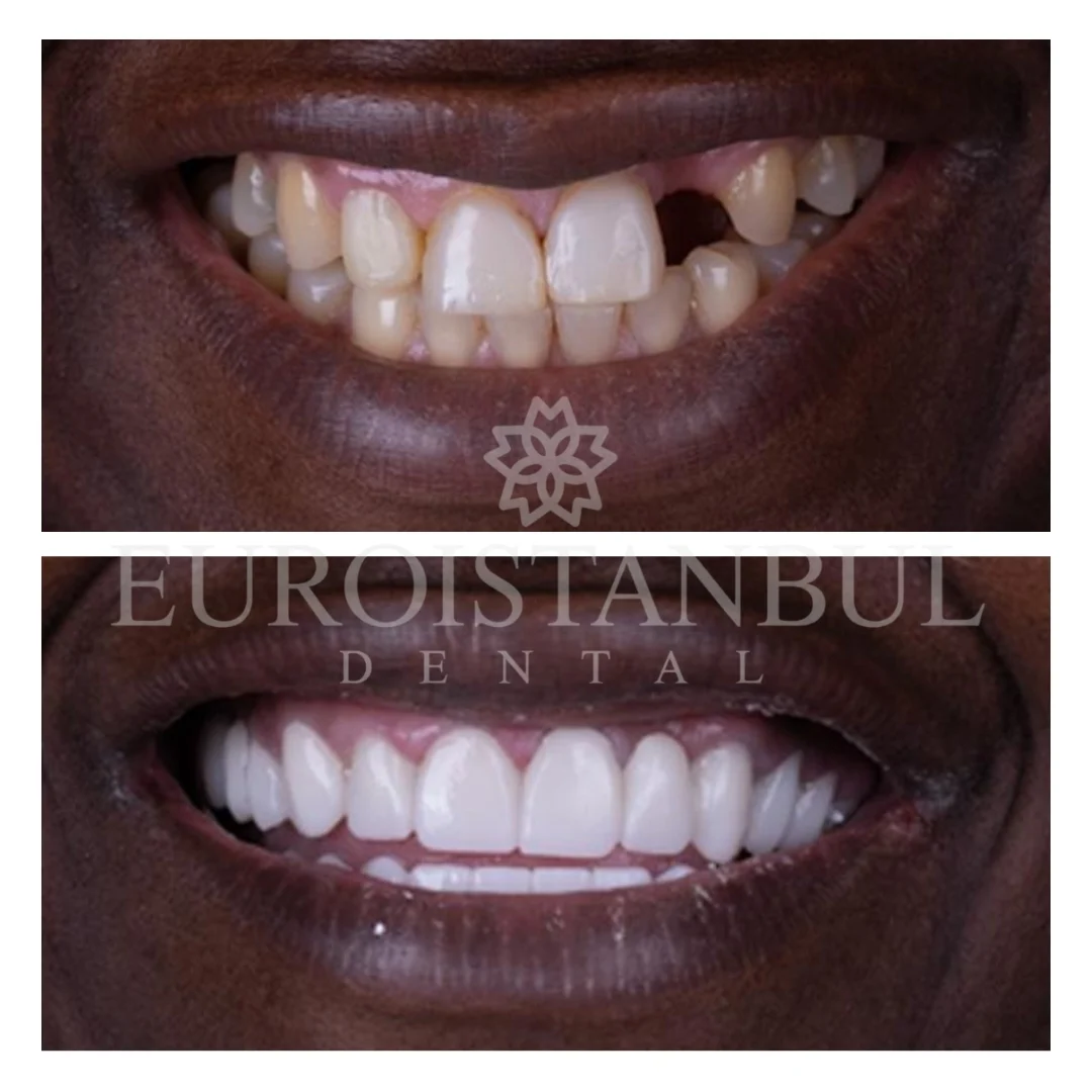 dental-implants-turkey-13