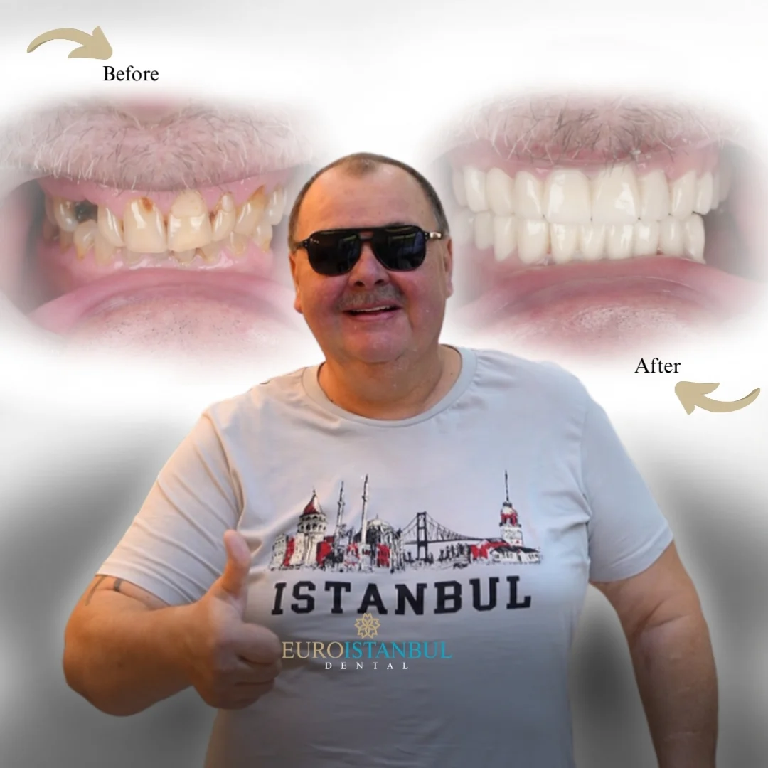 dental-implants-turkey-cost