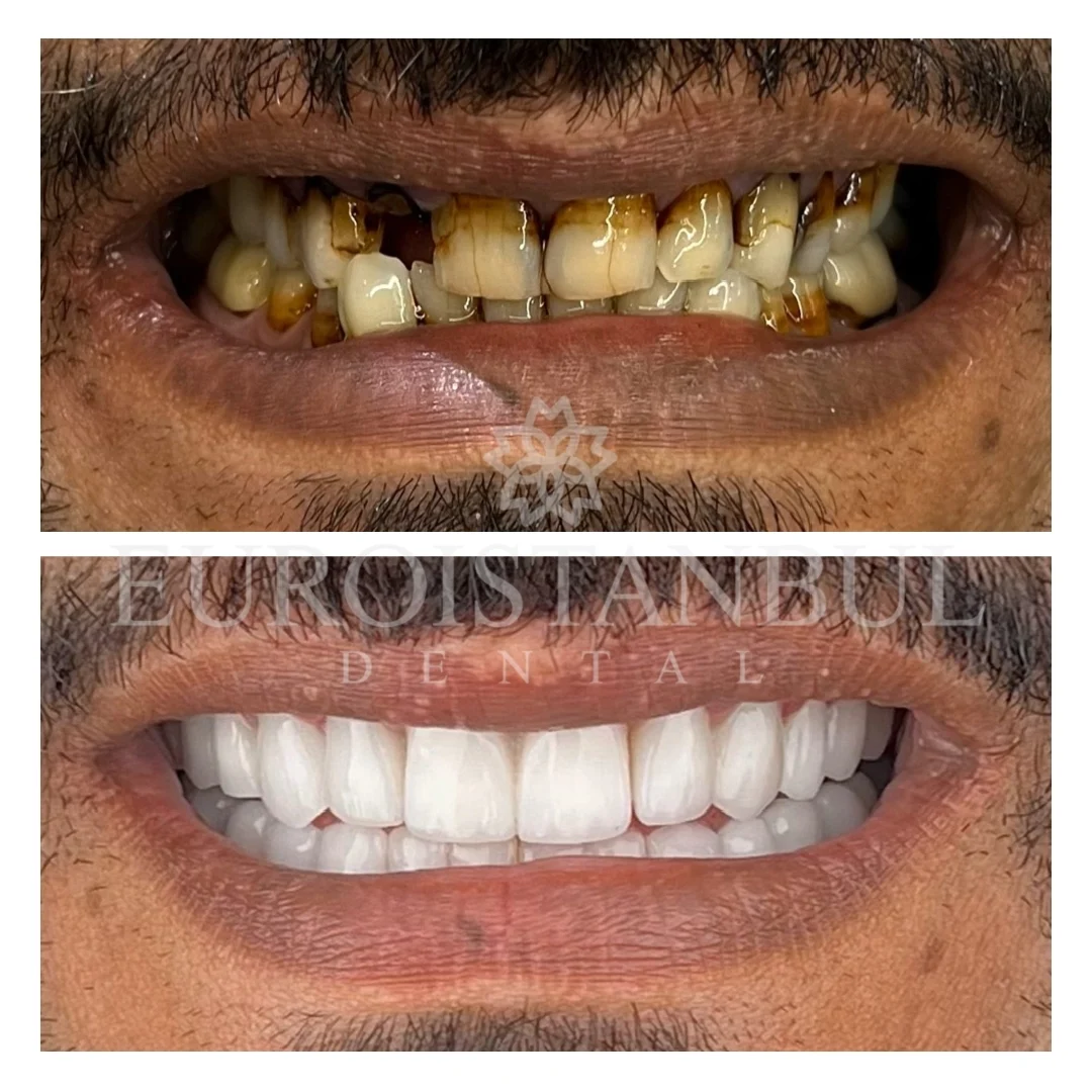 dental-implants-turkey-istanbul-11