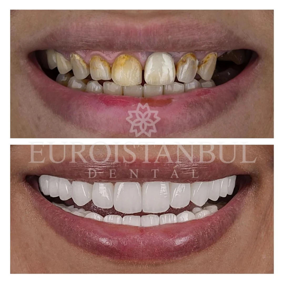 dental-implants-turkey-istanbul-12