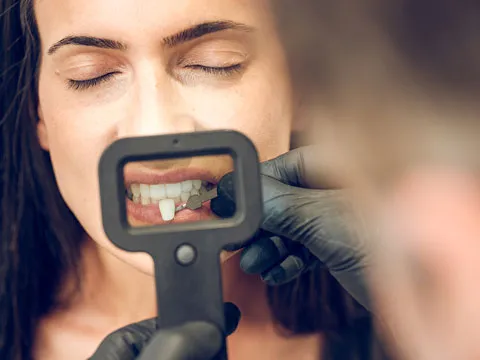 dental-laminate-veneers-list