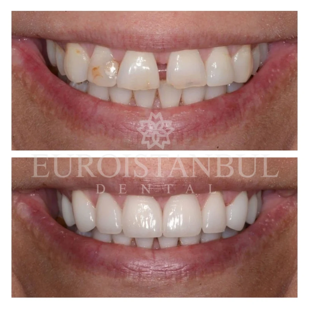 dental-porselen-crown-turkey-11