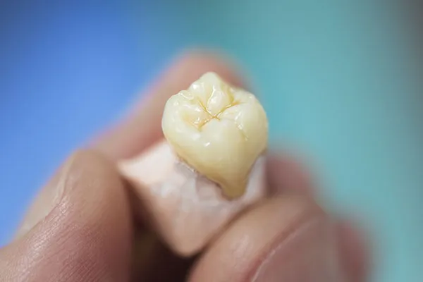 dental-prosthesis