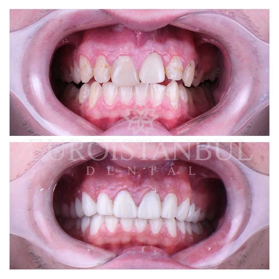 dental-veneer-istanbul-11