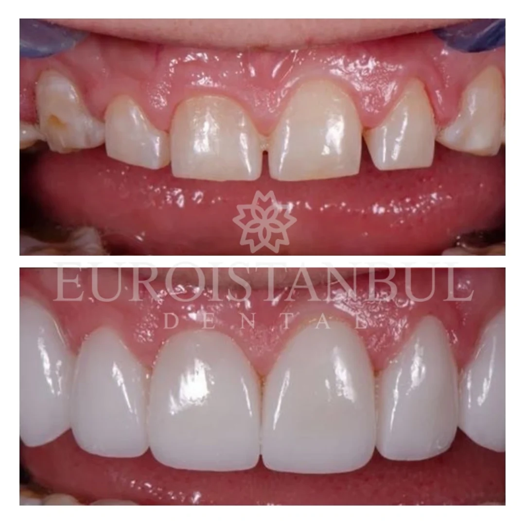 dental-veneer-istanbul-12