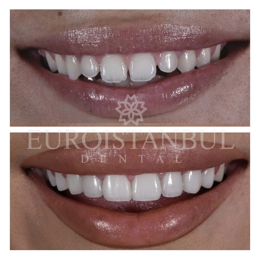 dental-veneer-istanbul-13