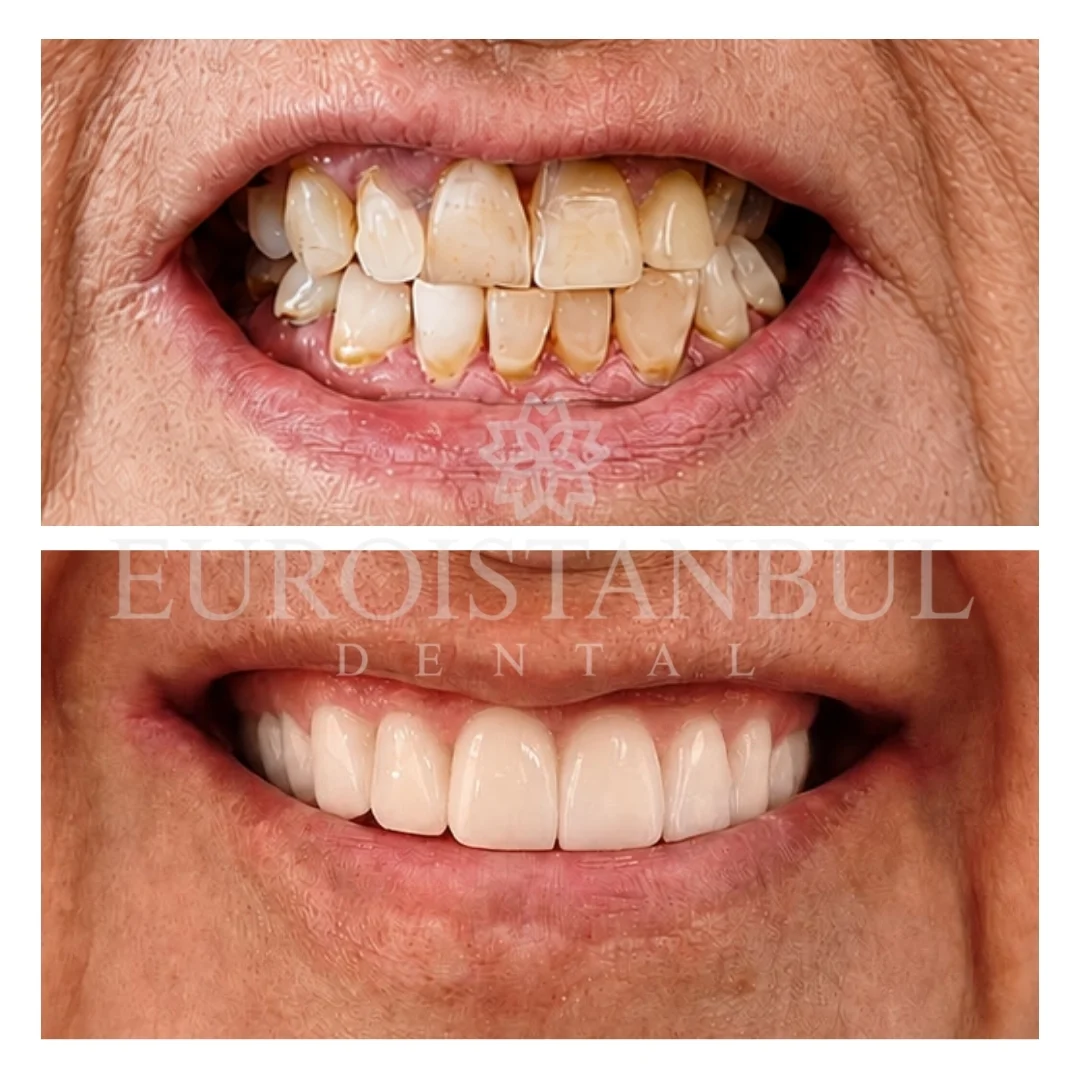 dental-veneer-istanbul-14