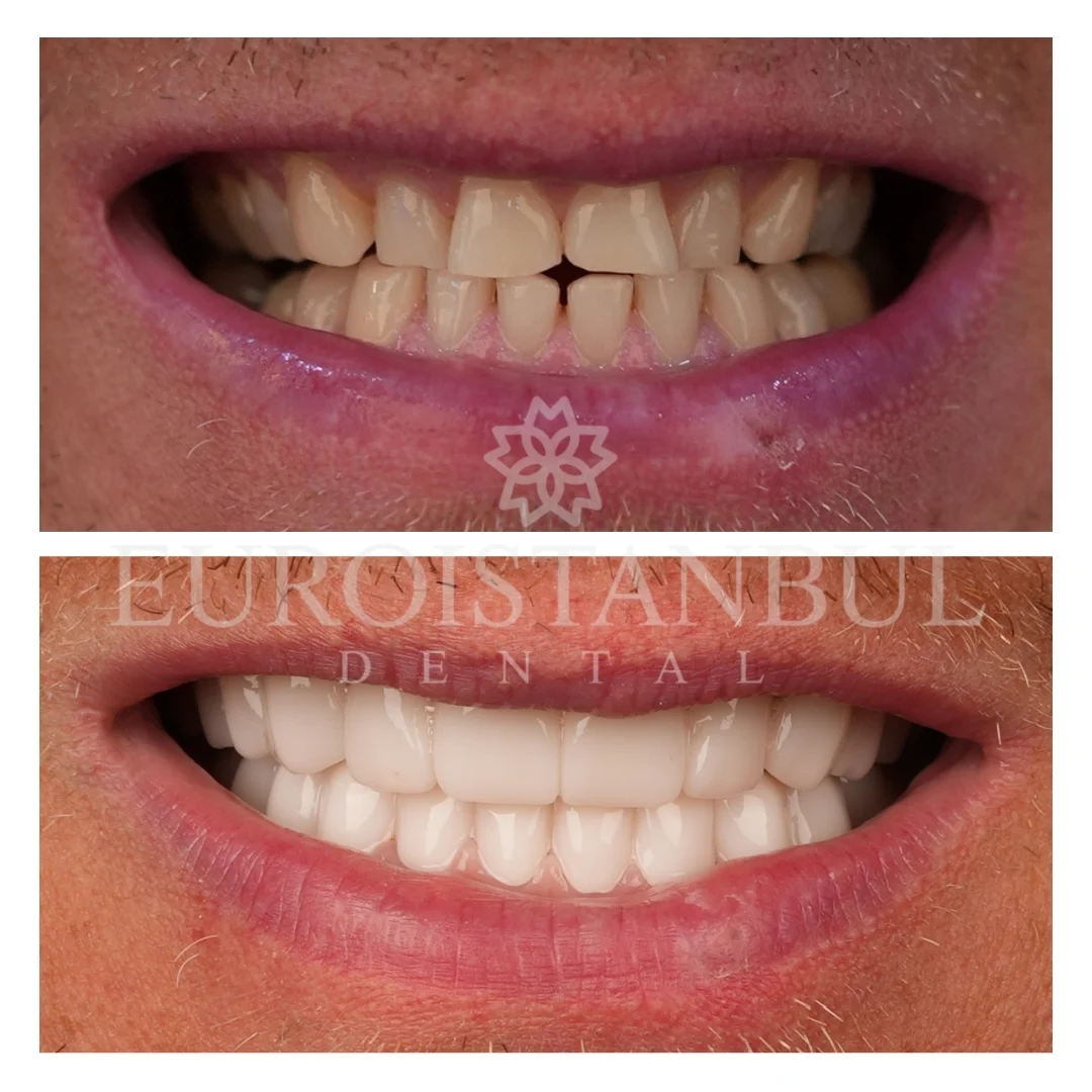 dental-veneer-istanbul-cost
