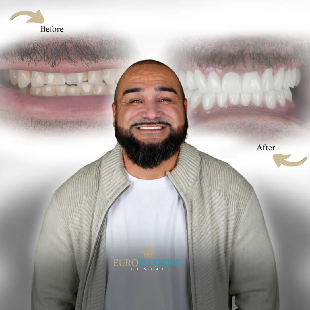dental-veneer-istanbul