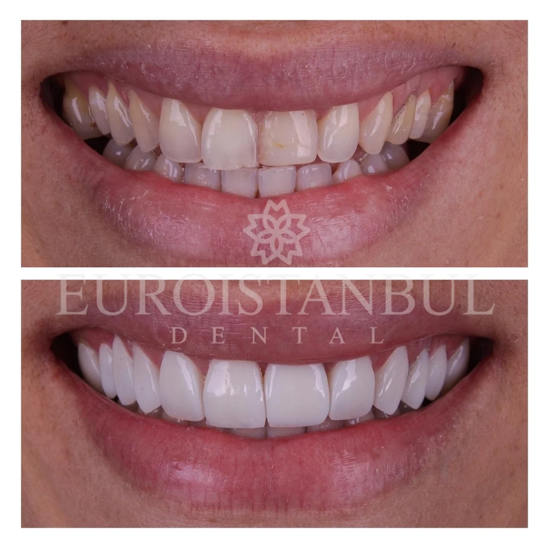 dental-veneer-turkey-11