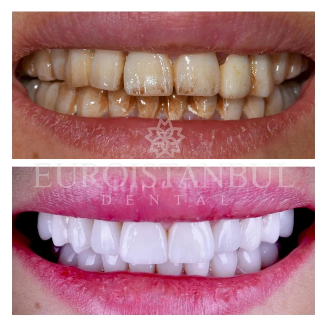 dental-veneer-turkey-12
