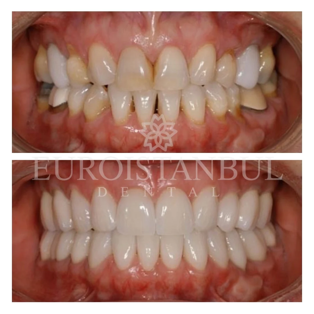 dental-veneer-turkey-13