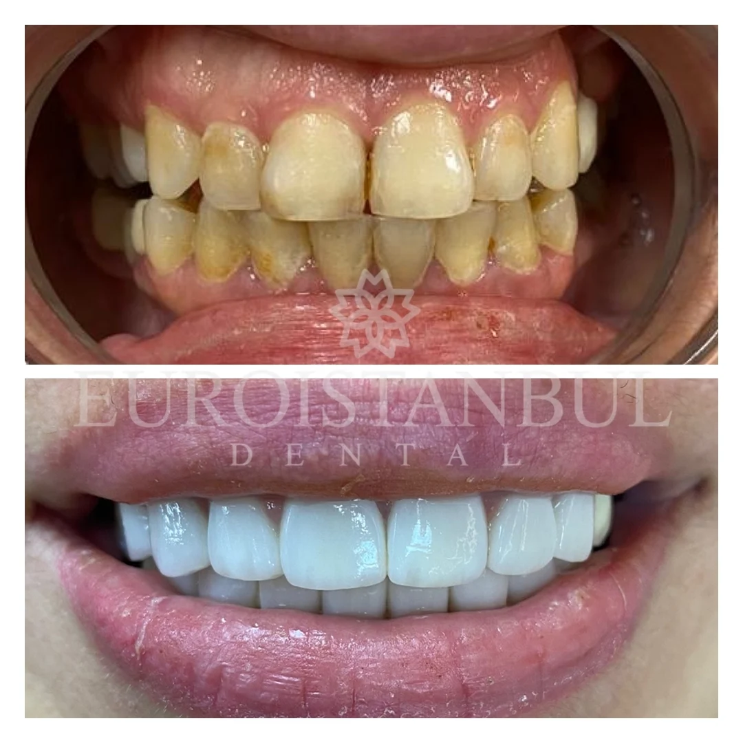 dental-veneer-turkey-cost