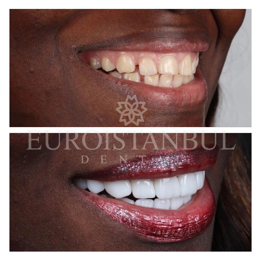 dental-veneer-turkey-cost-2