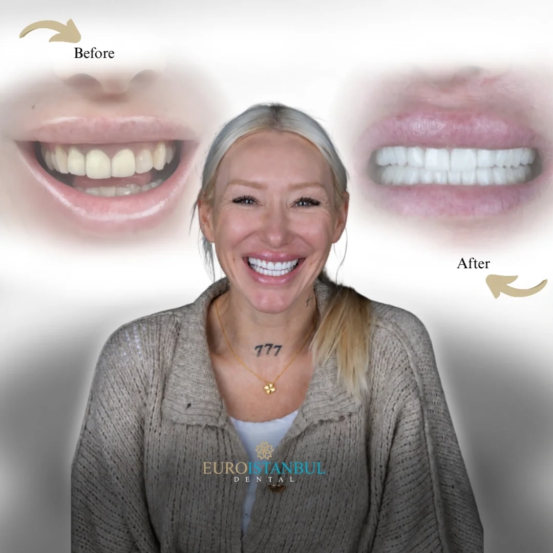 dental-veneer-turkey-cost